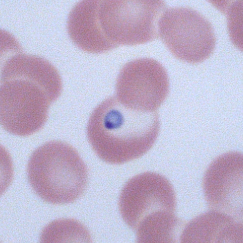 Malaria