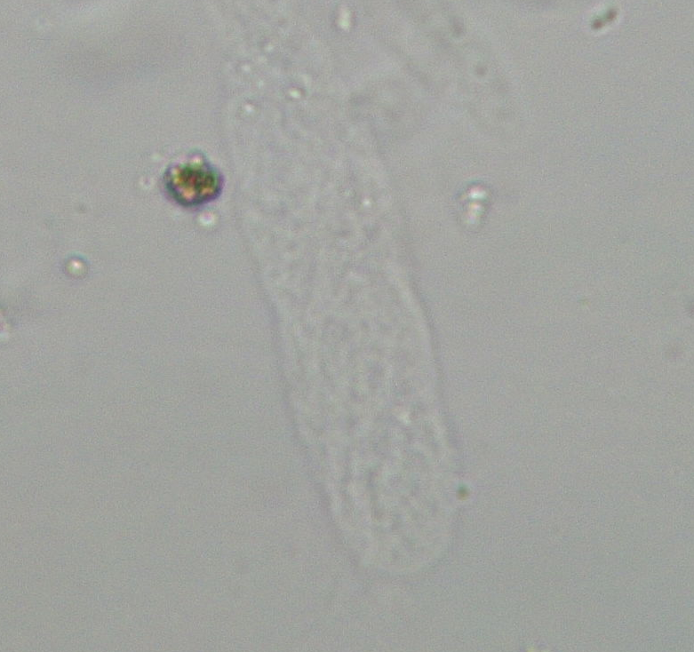 Urine Cast